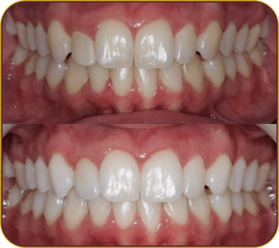 dentes-carrosel-2