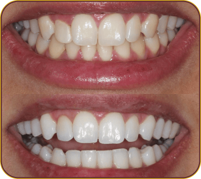 dentes-carrosel-3