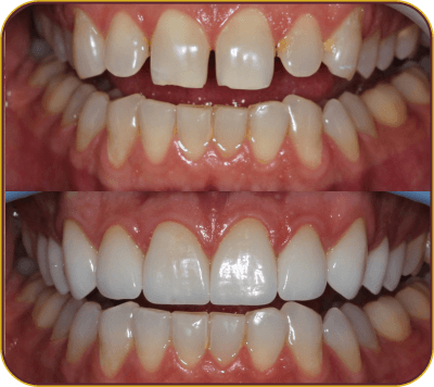 dentes-carrosel-4
