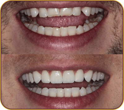 dentes-carrosel-5